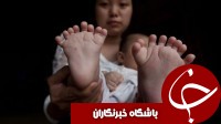 پسربچه چینی با 31 انگشت!+ تصاویر