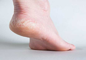 علائم خارپاشنه را بشناسید