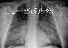 سل بیماری عفونی واگیردار