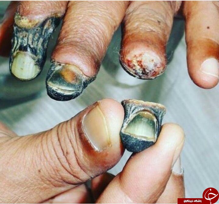 تصویری هولناک از کنده شدن انگشتان دست بر اثر قانقاریا (+18)