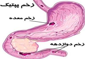 زخم دوازدهه (اثنی عشر) با گرسنگی تشدید می شود