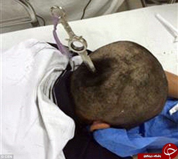 نجات معجزه آسا پس از برخورد خنجر به جمجمه + تصاویر