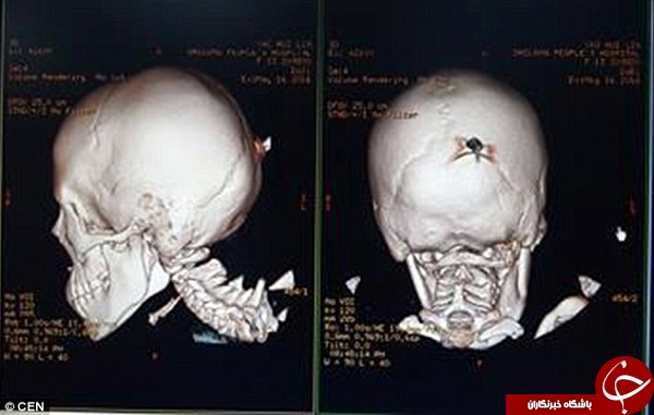 نجات معجزه آسا پس از برخورد خنجر به جمجمه + تصاویر