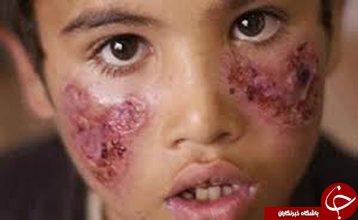 شیوع بیماری خطرناک پوستی درسوریه / این بیماری کشنده است !+عکس