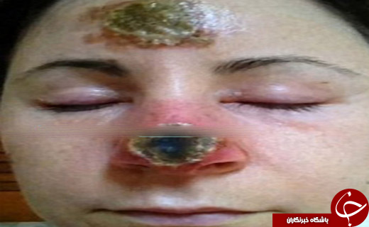 داروی گیاهی بینی زنی را از بین برد +عکس
