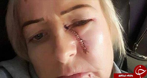 فاجعه ای وحشتناک که اتاقک داغ سولاریوم به بار آورد+ عکس