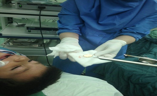 خروج سکه از مری کودک 2 ساله