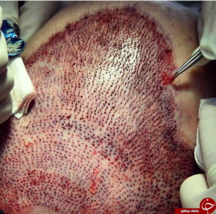 نمای بسیار نزدیک و جالب کاشت مو+ عکس
