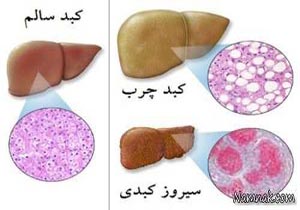 کبد چرب و روزه
