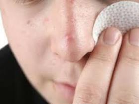 بروز آکنه در نتیجه بسته شدن فولیکول پوست