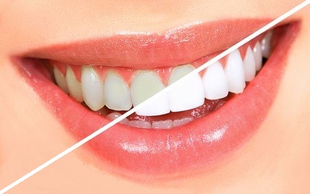 دلایل بدرنگی دندان ها چیست؟