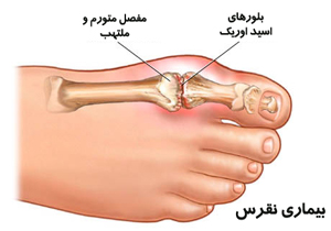 چرا نقرس می‌گیریم؟