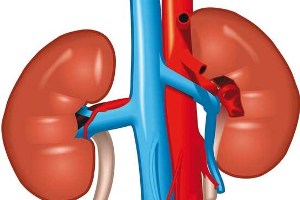 معجزه آب لیموی تازه در پیشگیری از ایجاد سنگ کلیه