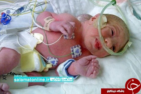 جداسازی بادکنک گوشتی از پشت سر نوزاد آمریکایی! + تصاویر