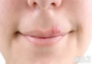 حساسیت به نور و درد و قرمزی چشم، علائمی از بروز تب خال!