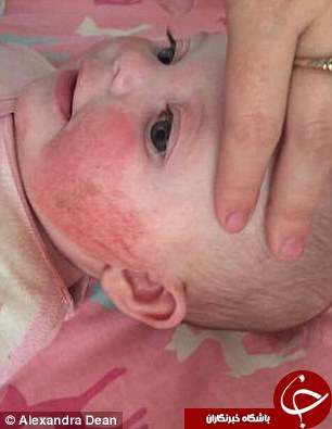 این کودک مجبور است همیشه دستکش بپوشد +تصاویر