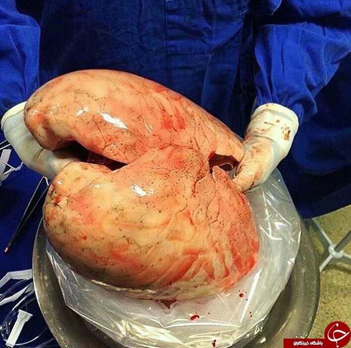 نمایی نزدیک از پیوند ریه+ عکس