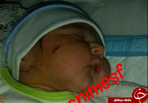 واقعیت ماجرای بریدگی گونه نوزاد اصفهانی چیست؟! +عکس