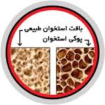 مصرف داروهای استروئیدی و سایر دارو ها و پوکی استخوان