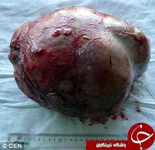 خارج کردن توموری به اندازۀ توپ بسکتبال از شکم یک بیمار+تصویر
