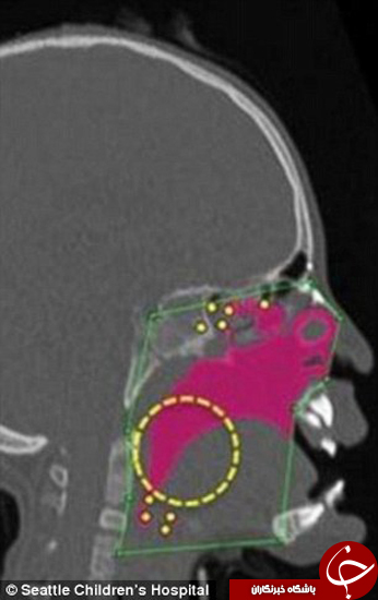 دختر 9 ساله بالاخره توانست بدون استفاده از لوله نفس بکشد +تصاویر