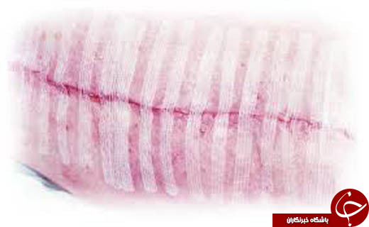 چسبی که جایگزین بخیه می شود+عکس