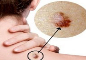 ویژگی های یک خال سرطانی