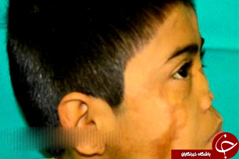 پزشک هندی، روی پیشانی پسری، دماغ کاشت! +عکس