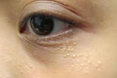 علت جوش های سفید  رنگ زیر چشم چیست؟