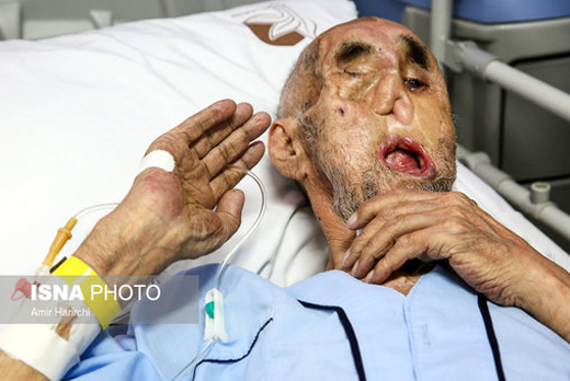 جانبازی که همه چهره&zwnj;اش ساخته پزشکان است +تصاویر