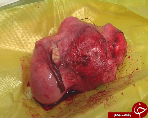 خروج توده 3 كيلويي از شکم زن 49 ساله سبزواري+ تصاویر