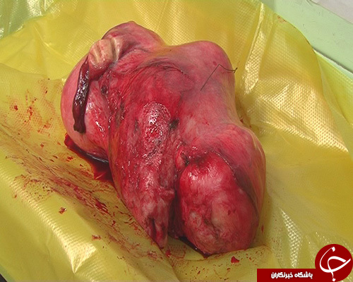 خروج توده 3 كيلويي از رحم زن 49 ساله سبزواري+ تصویر