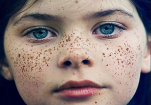 نسخه‌هایی برای خلاصی از کک و مک پوستی
