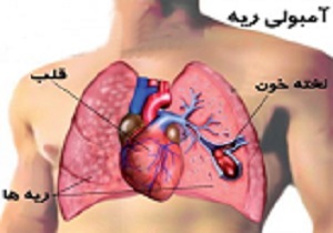 آمبولی چربی بیشتر در شکستگی های استخوان