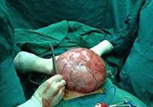 خارج کردن کیست بزرگ شش کیلویی ازداخل شکم خانم 60 ساله