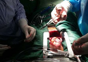 اولین جراحی باز پیوند عروق قلب در قزوین