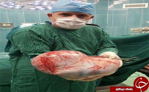 توده ۱۳ کیلویی از بدن بیمار کرجی خارج شد+ عکس