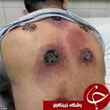 تصویر وحشتناک از بادکش درمانی(+18)