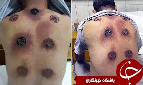 تصویر وحشتناک از بادکش درمانی(+18)