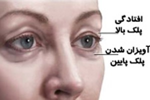 دلایل ایجاد پف چشم