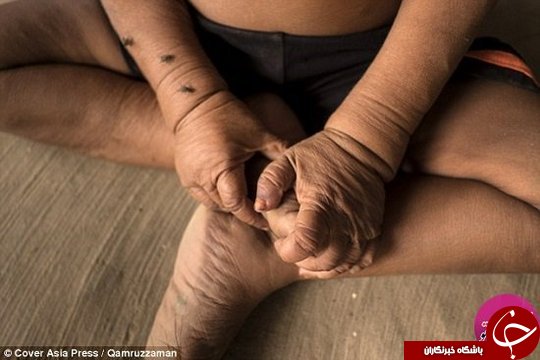 کودکی که دچار بیماری پیری زودرس شده است+تصاویر