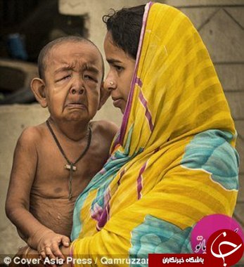 کودکی که دچار بیماری پیری زودرس شده است+تصاویر