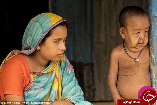 کودکی که دچار بیماری پیری زودرس شده است+تصاویر