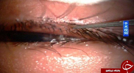 بیرون کشیدن شپش از مژه دختر 5 ساله +تصاویر