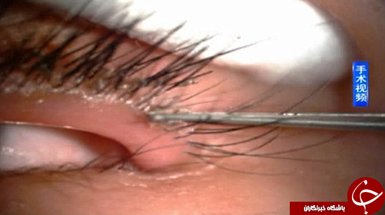 بیرون کشیدن شپش از مژه دختر 5 ساله +تصاویر