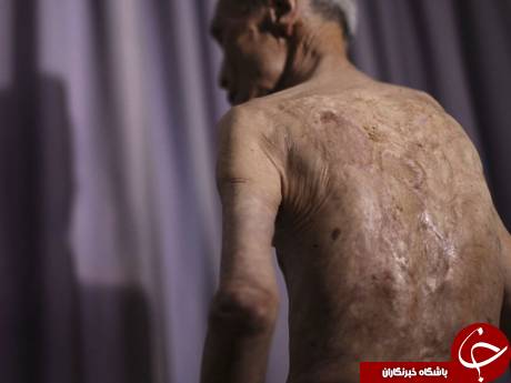 تصاویر بلایی که بمب اتم بر سر انسان آورد! 18+