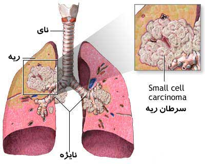 همدان در ماراتن سرطان ریه