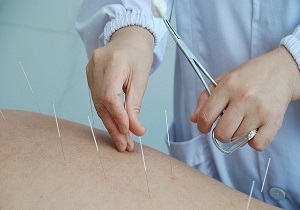 طب سوزنی به مقابله با آلزایمر کمک می‌کند؟