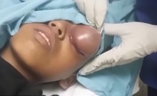 لحظه وحشتناک خارج کردن کیست از چشم کودک 10 ساله + تصاویر