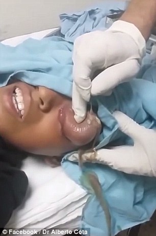 لحظه وحشتناک خارج کردن کیست از چشم کودک 10 ساله + تصاویر
